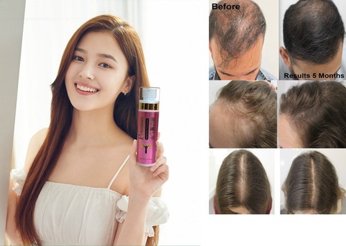 Hair loss baldness serum - hair, for